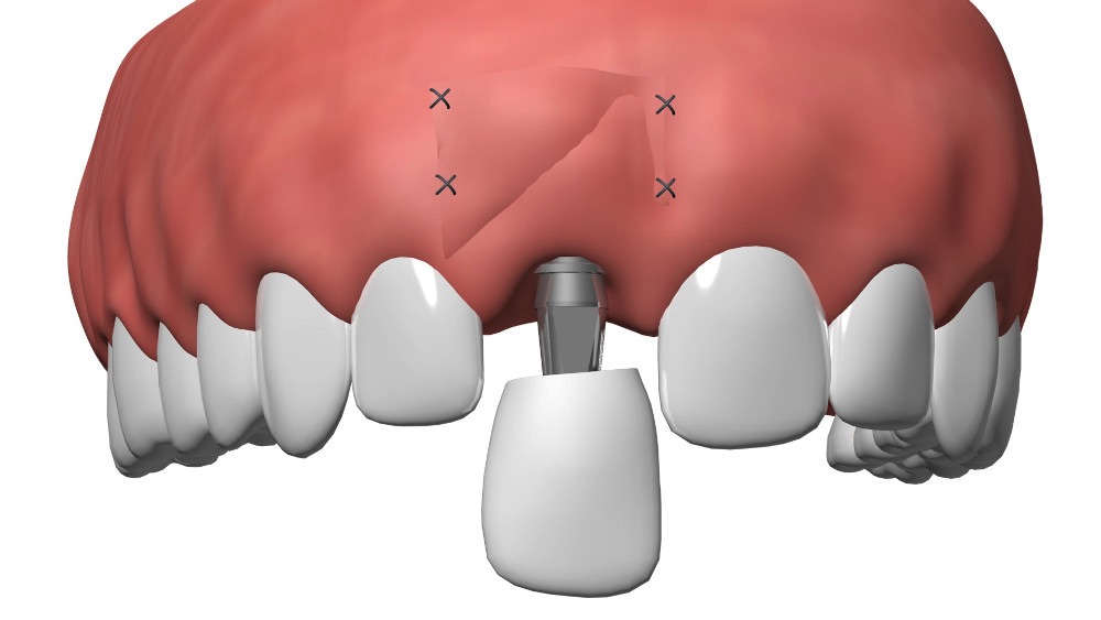 Implant dentaire Nimes David Fernandez